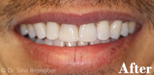 Bonding on Front Left Tooth After
