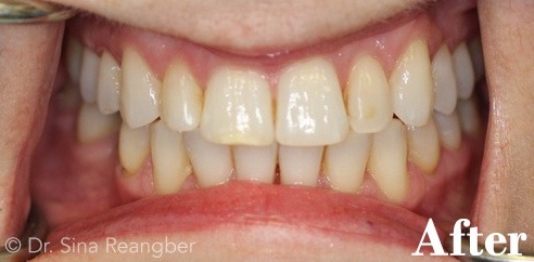Bonding on Front Left Tooth and Minor Invisalign Treatment after