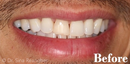 Bonding on Front Left Tooth Before