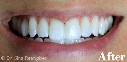 Bonding to Close Dark Space Between Two Front Teeth After