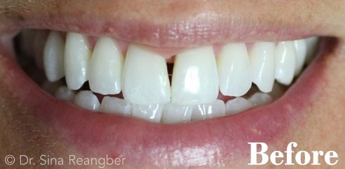 Bonding to Close Dark Space Between Two Front Teeth before