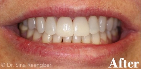 Cosmetic Bonding After