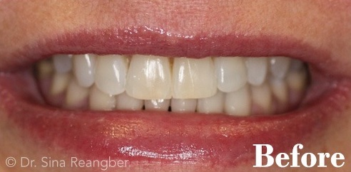 Cosmetic Bonding Before