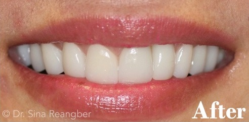 Cosmetic Implant Crowns and Traditional Crowns after