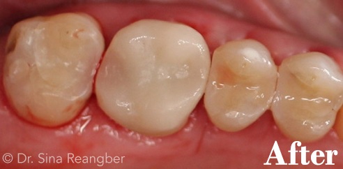 Crown and Fillings after