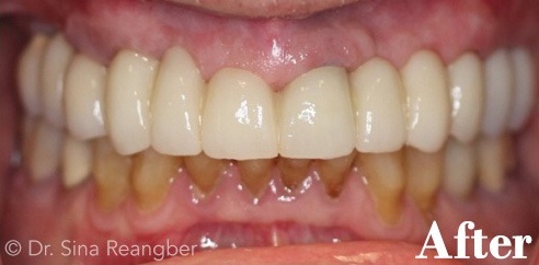 Fixed Implant Supported Bridge after