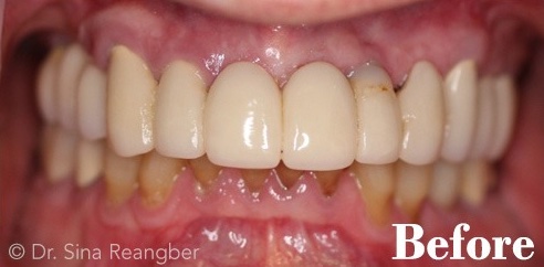 Fixed Implant Supported Bridge before