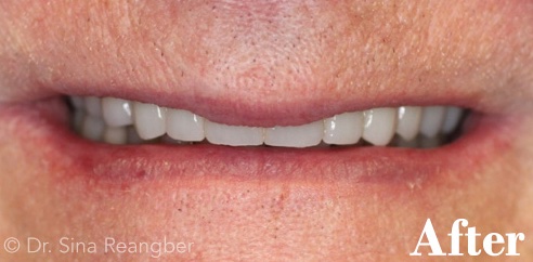 Implant Supported Crowns and Bridges after