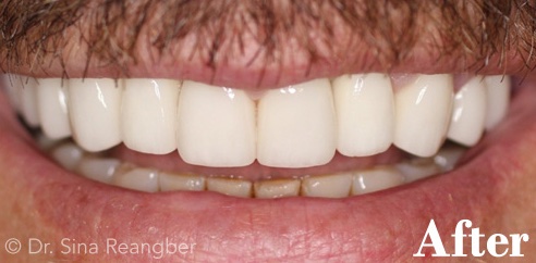 Implant and Porcelain Crowns after