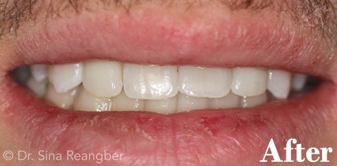 Implant Crowns for Missing Lateral Teeth after