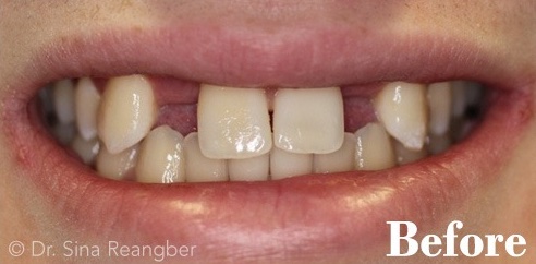 Implant Crowns for Missing Lateral Teeth before