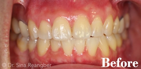 Invisalign before