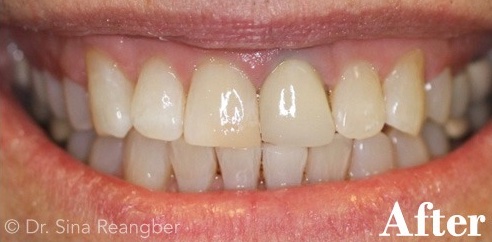 Invisalign 11 after
