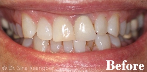 Invisalign 11 before