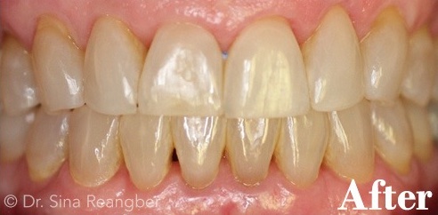 Invisalign 12 after