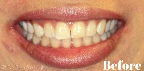 Invisalign 13 before