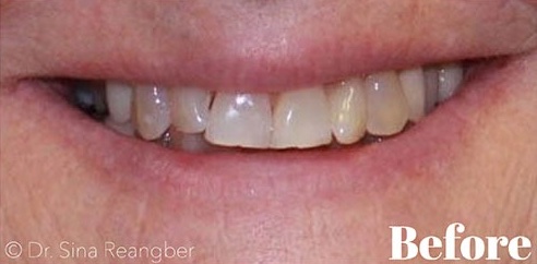 Invisalign 14 before