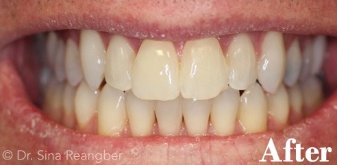 Invisalign 2 after