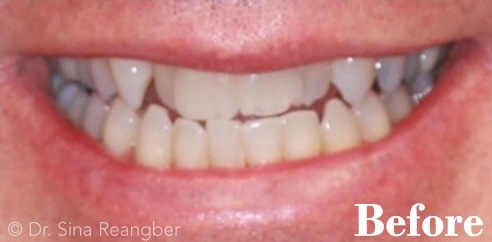 Invisalign 2 before