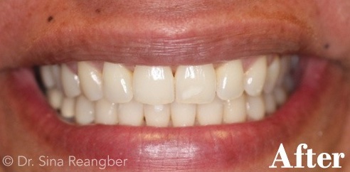 Invisalign 4 after