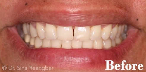 Invisalign 4 before