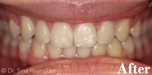 Invisalign 5 after