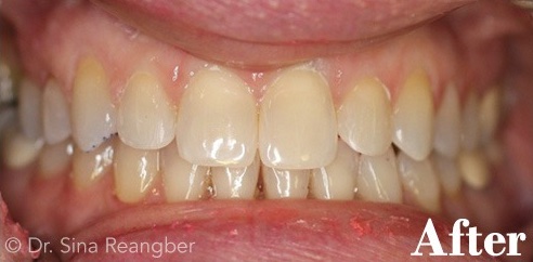 Invisalign 6 after
