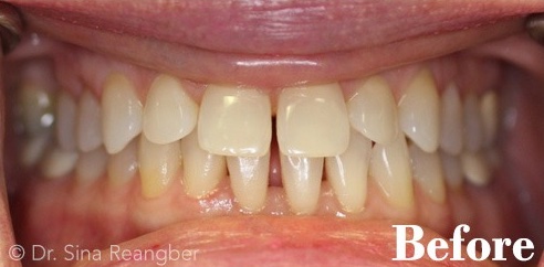 Invisalign 6 before