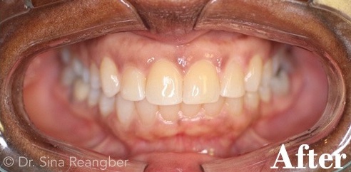 Invisalign 7 after