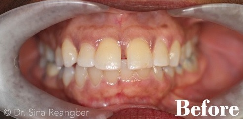 Invisalign 7 before