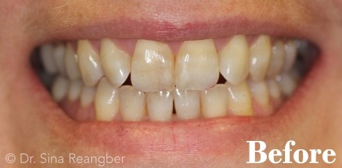 Invisalign 9 before