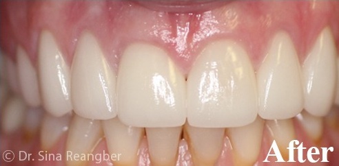 Porcelain Crowns 1 After