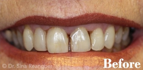 Porcelain Crowns 10 before