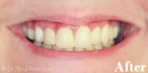 Porcelain Crowns 11 after