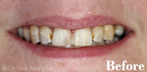 Porcelain Crowns 11 before