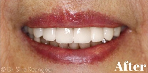 Porcelain Crowns 12 after