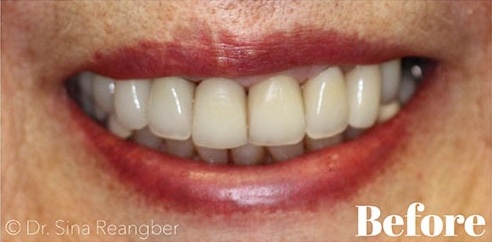 Porcelain Crowns 12 before