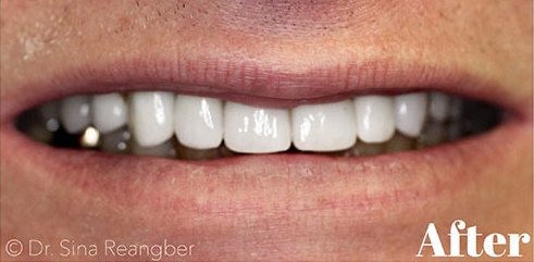 Porcelain Crowns 13 after