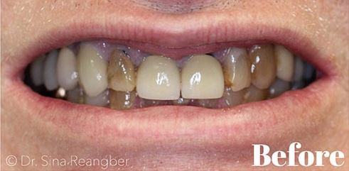 Porcelain Crowns 13 before