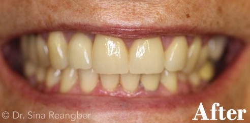 Porcelain Crowns 2 after