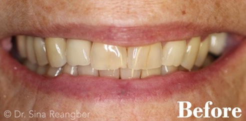 Porcelain Crowns 2 before