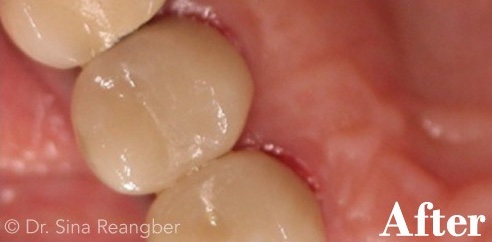 Porcelain Crowns 3 after