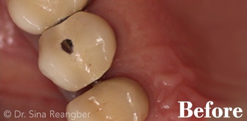 Porcelain Crowns 3 before