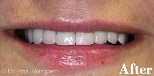 Porcelain Crowns 4 after