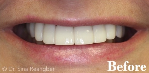 Porcelain Crowns 4 after