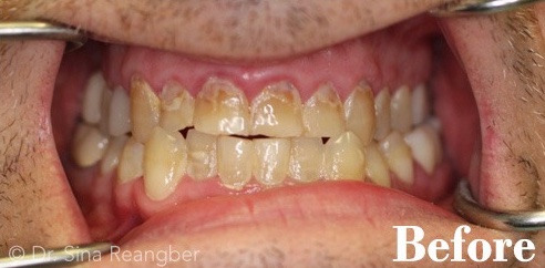 Porcelain Crowns 5 before