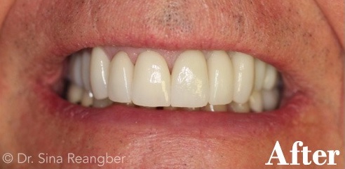 Porcelain Crowns 7 after