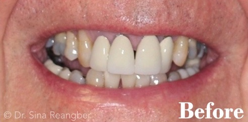 Porcelain Crowns 7 before