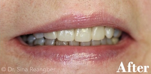 Porcelain Crowns 8 after
