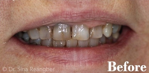 Porcelain Crowns 8 before